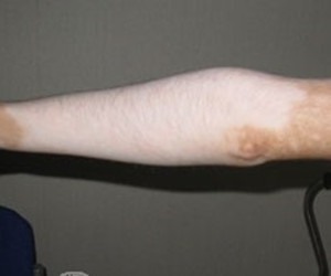 肢端型白斑病有哪些危害
