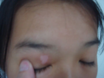 怎么治疗眼睛周围白癜风