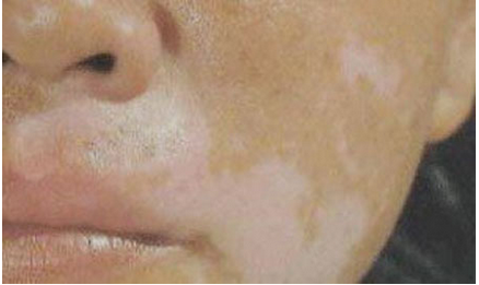白癜风患者论坛：脸部白癜风初期有哪些症状表现
